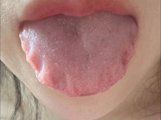 舌头上有齿痕,是湿气重吗?需要治疗吗?