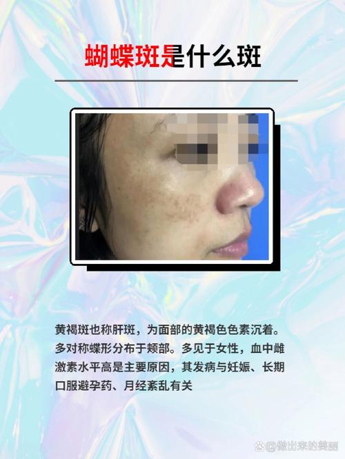 为何非同一般的“蝴蝶斑”更偏爱女性?
